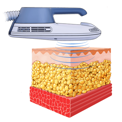 Jupiter emsculpt treatment diagram