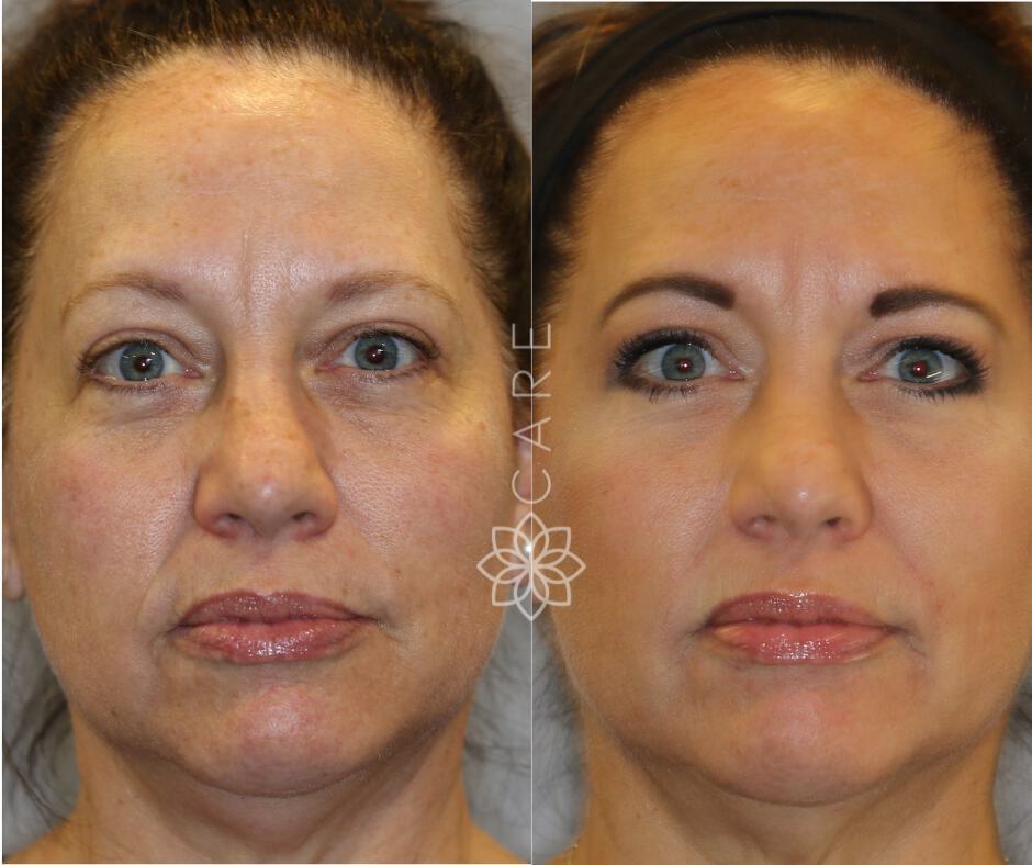 Facial Rejuvenation Before & After Image